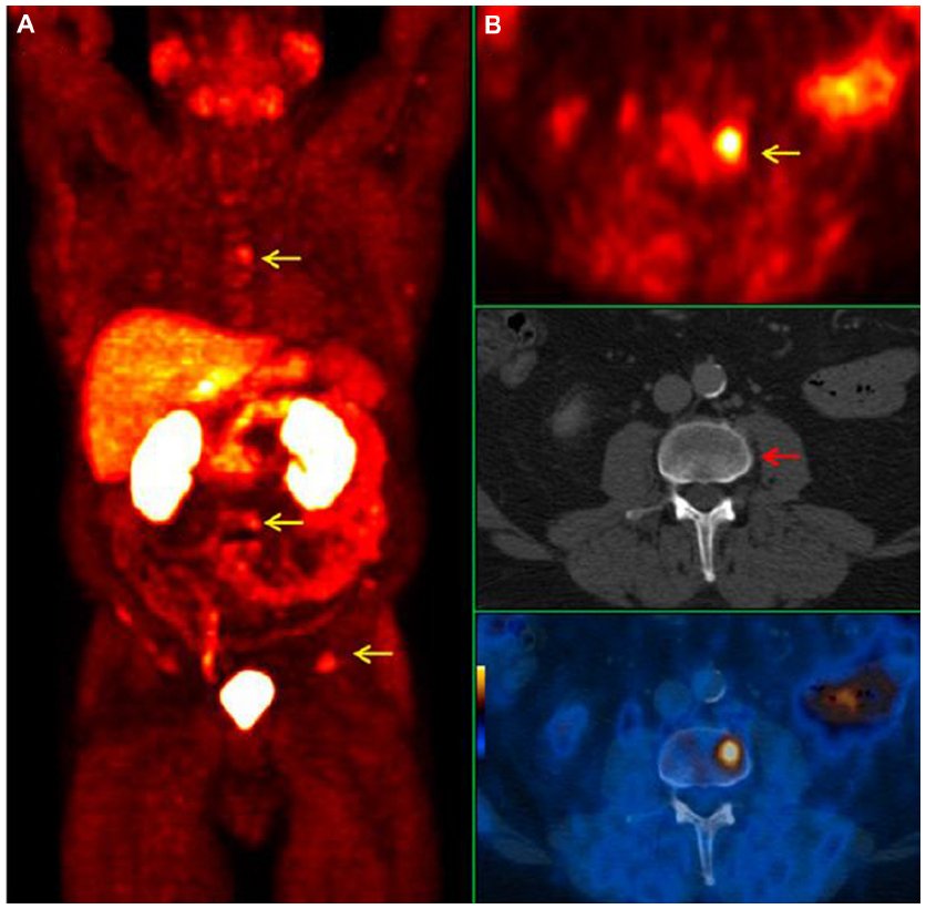 PSMA pet ct scan | PPTX