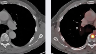 psma pet scan near me Discover Local Solutions