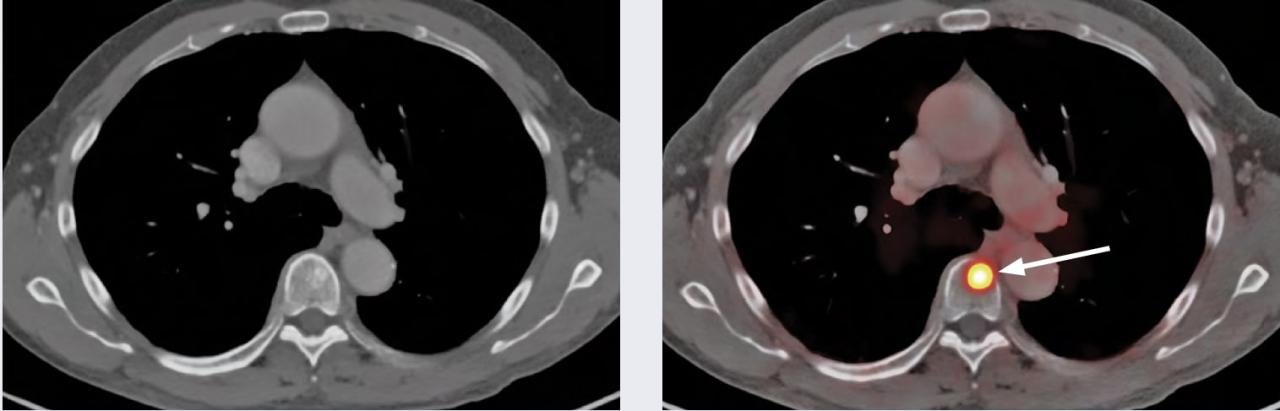 Nueclear | F18 PSMA PET Scan | Prostate Imaging Cancer | Nueclear